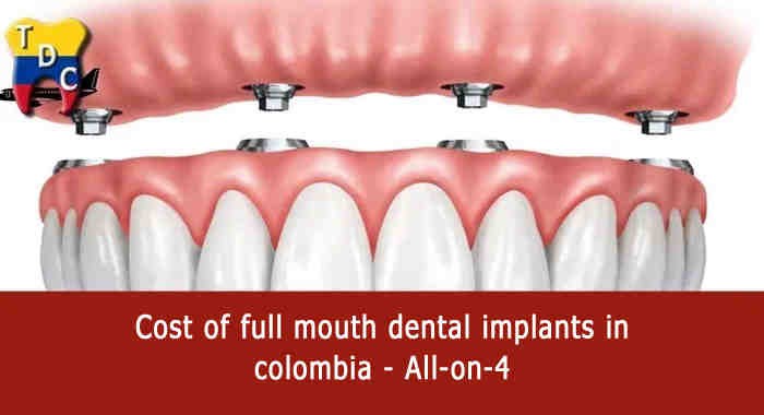 Can I get a full mouth of dental implants?