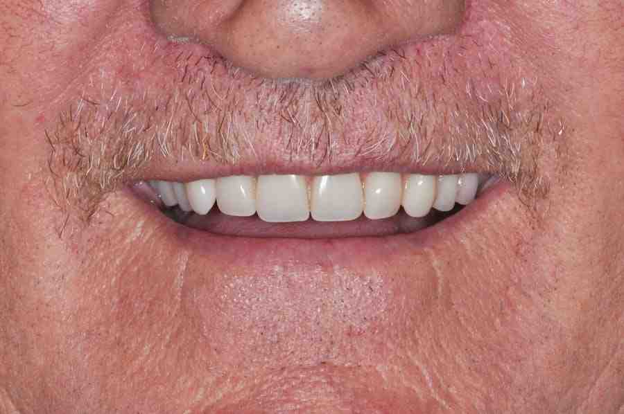 Can I get a full mouth of dental implants?