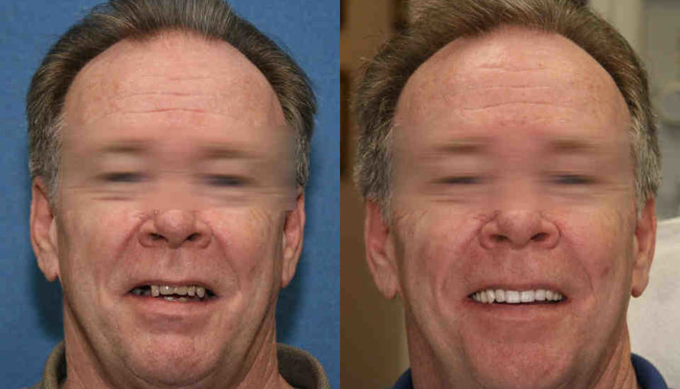 Can a dental implant fall out