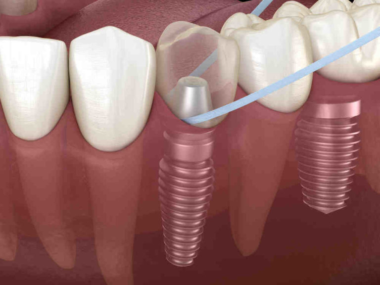 Will it cause further damage to floss a loose dental implant Dental