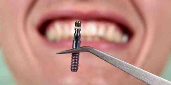 Can a normal dentist do implants?