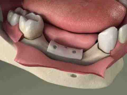 Can any dentist do a bone graft?