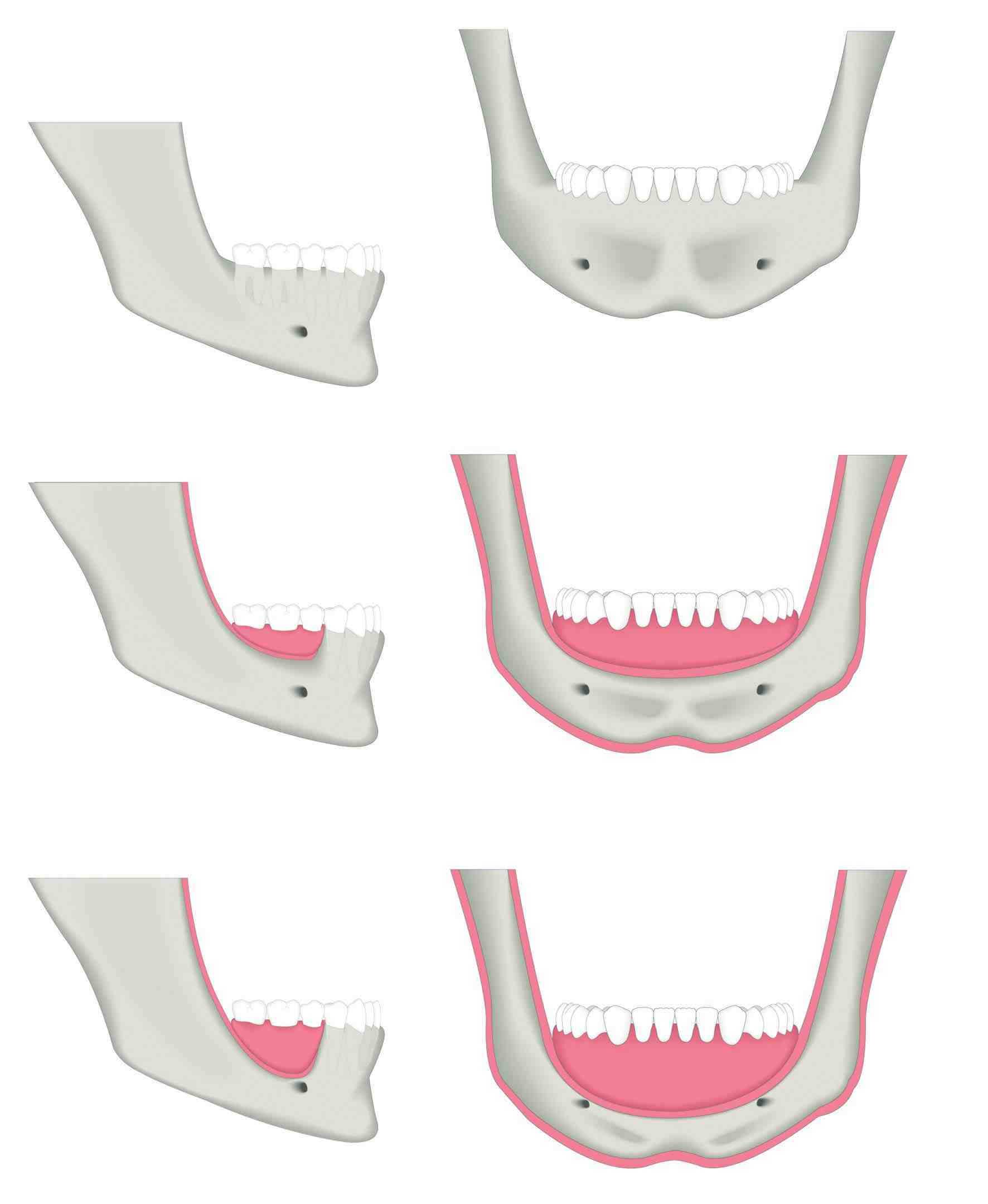 What is dental implant with bone graft Dental News Network
