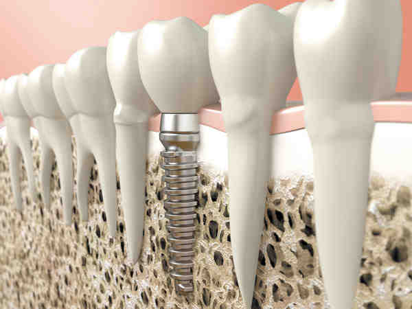 Can dental implants affect your health?