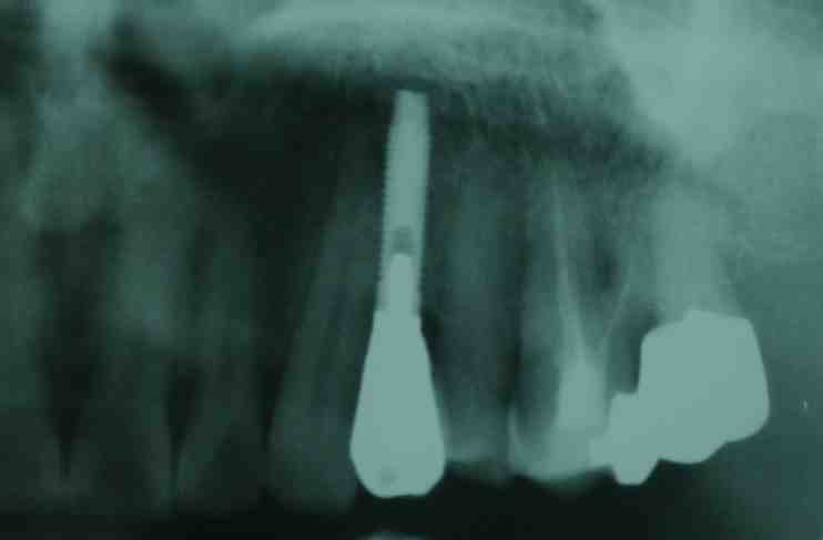 could-dental-implant-hit-nerve-dental-news-network