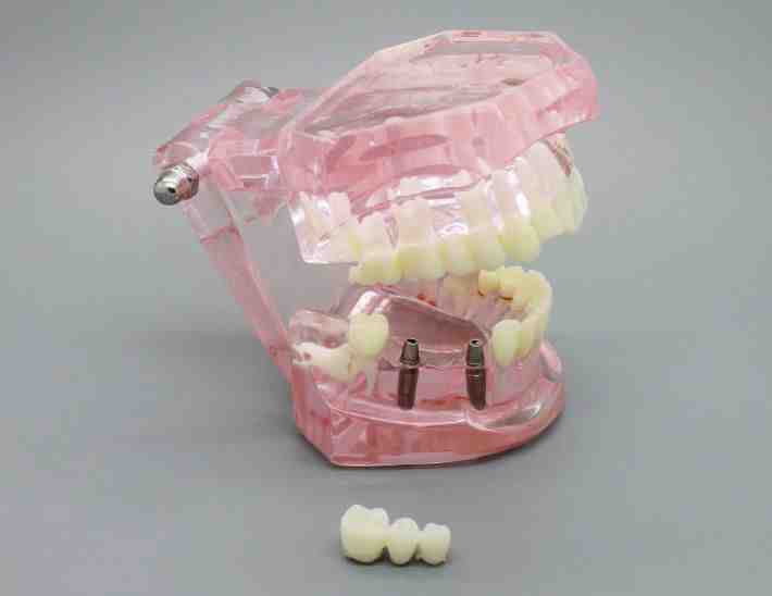 Can fake teeth be implanted?