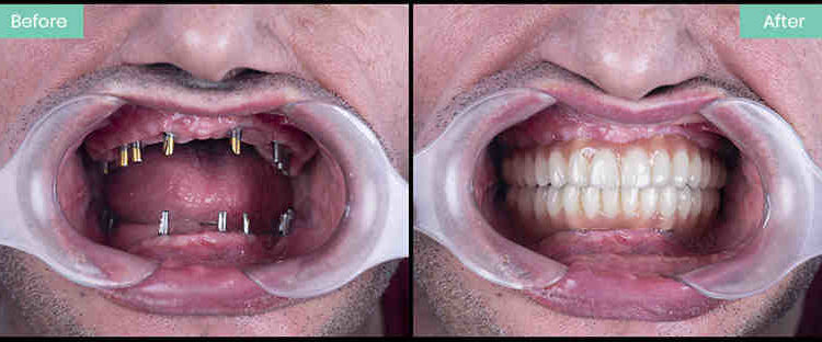 Can i apply for dental implants