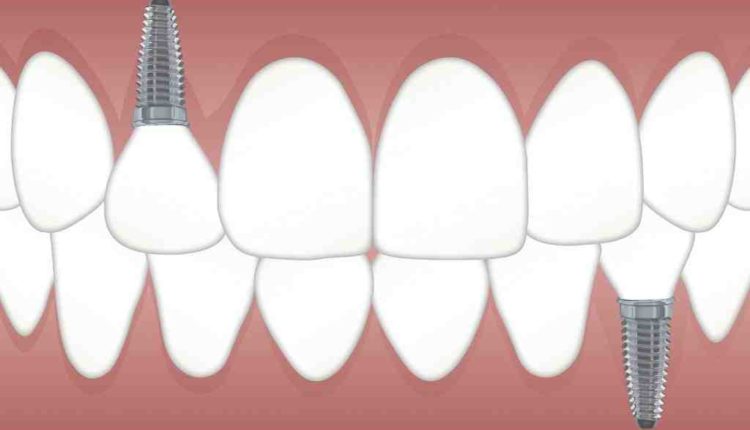 Can medicaid pay for dental implants