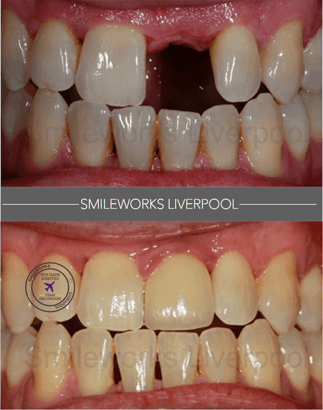 Can missing teeth make your face sag?