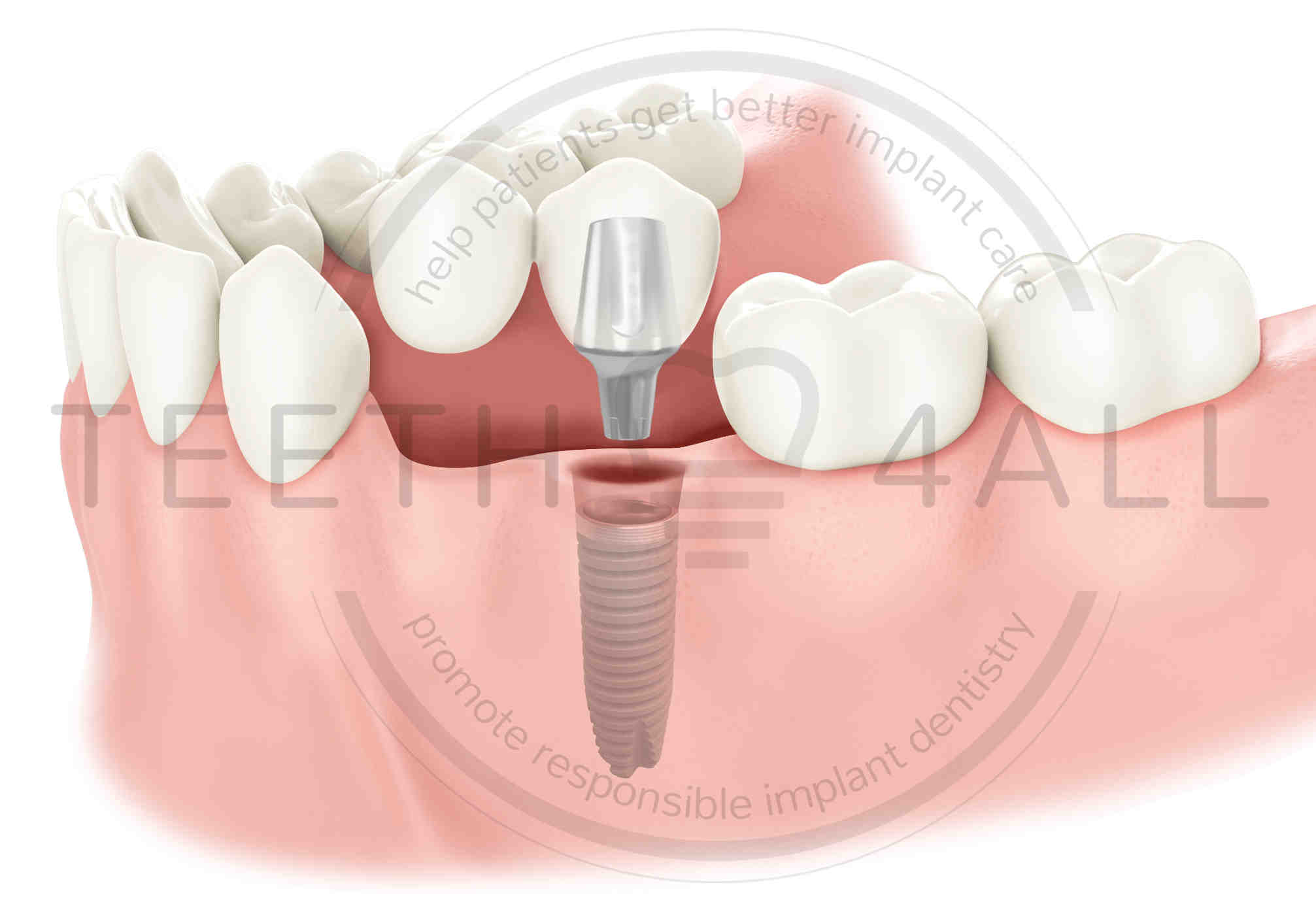 Can you damage a tooth implant?