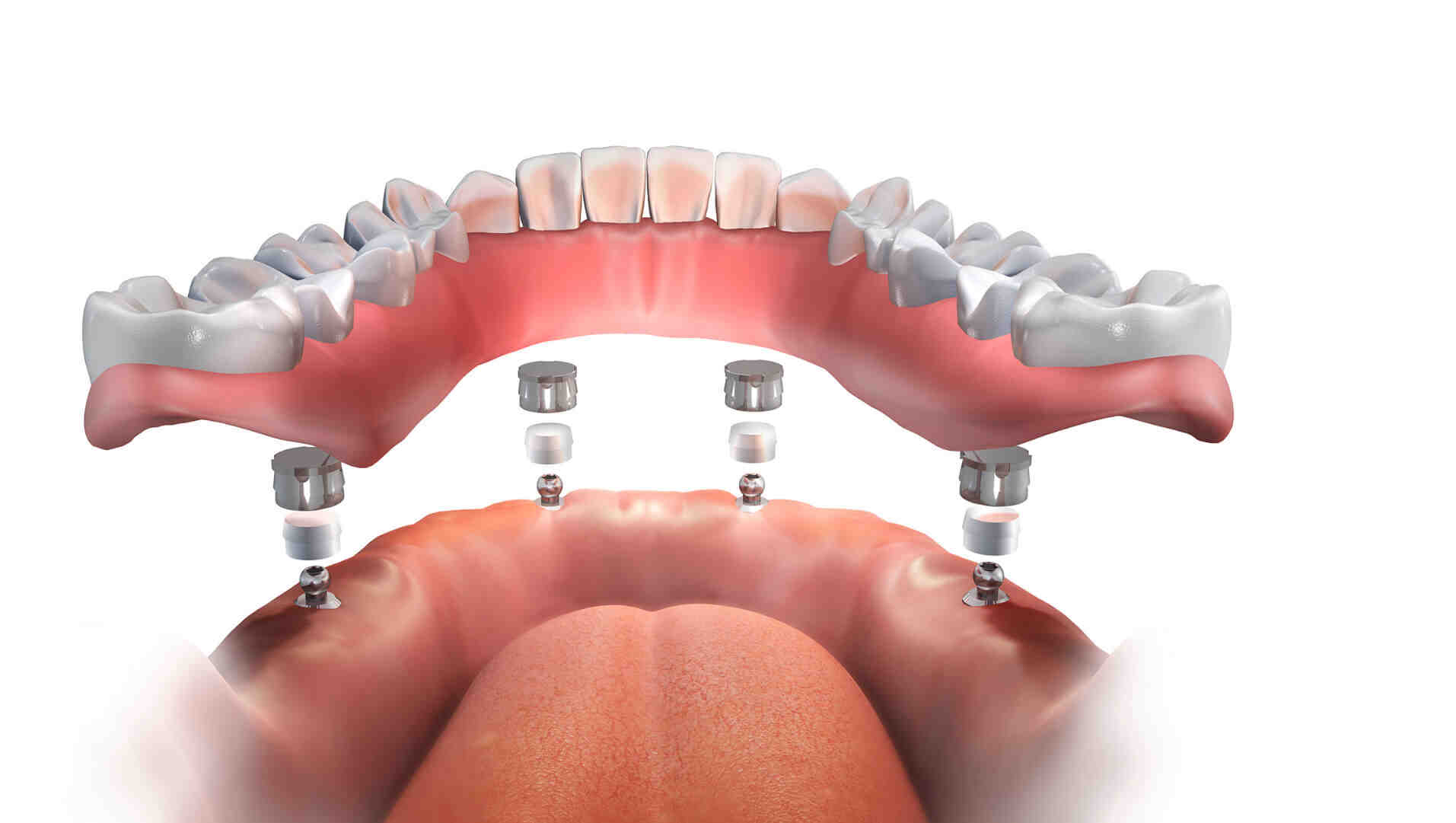 How many dental implants are needed for dentures Dental News Network