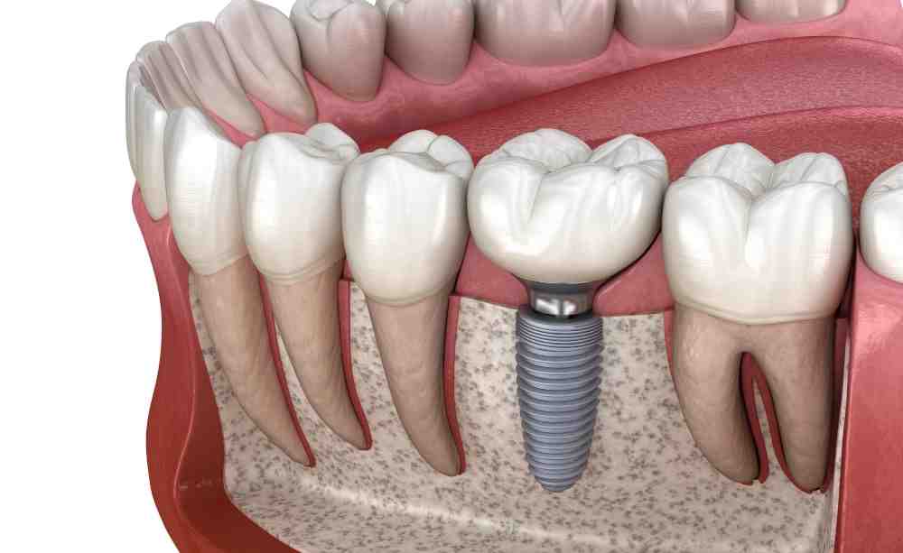 How much bone is needed for a dental implant Dental News Network