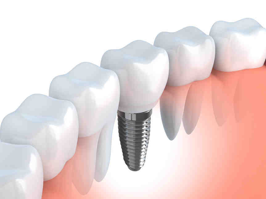 Can you get immediate dental implants?