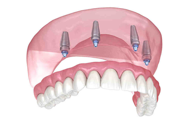 Can be installed dental implants in one day Dental News Network
