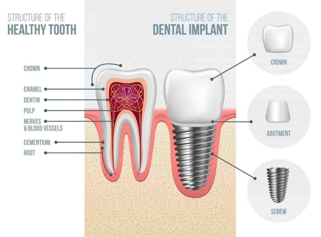 Could dental implant hit nerve Dental News Network