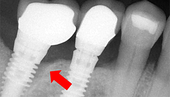 Can you have a CT scan with dental implants?