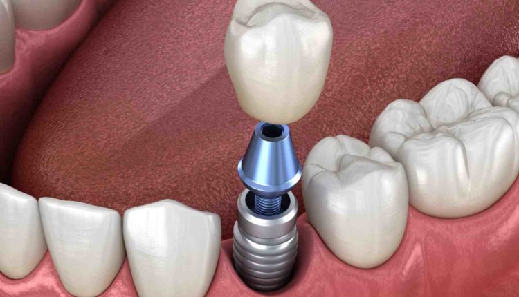 Cosmetic dentistry portland implants bone grafts