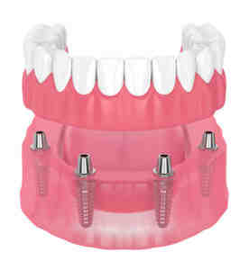 Do dental implants break easily?