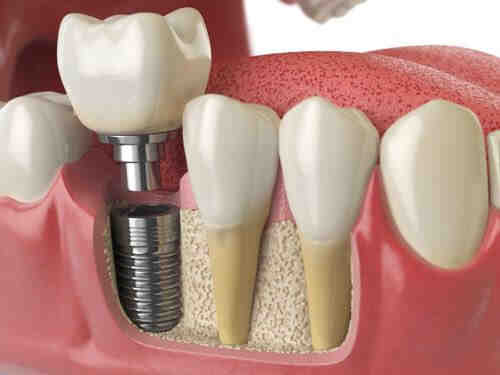 Do dental implants feel real Reddit?