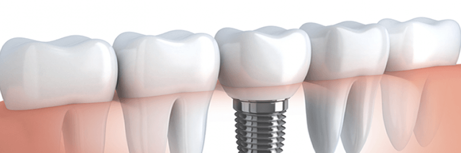 Do dental implants have an expiration date?