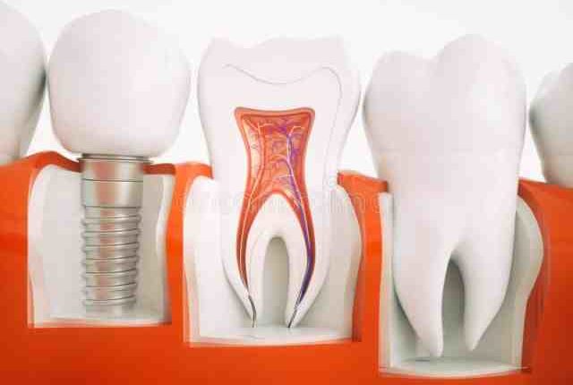 Do dental implants have to be replaced