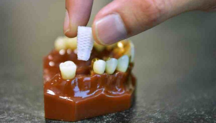 Do dental implants hurt reddit