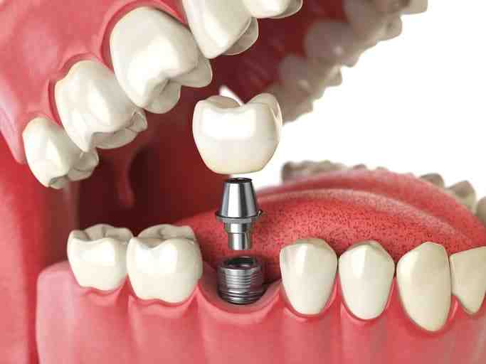 How do they put in dental implants Dental News Network