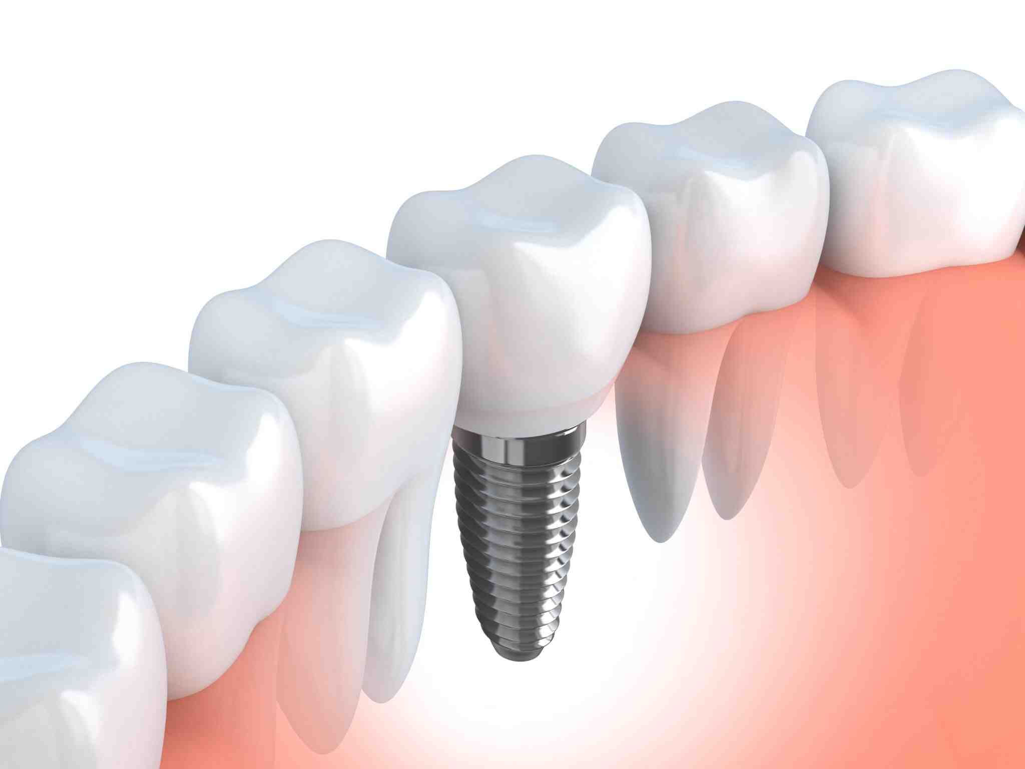 Do dental implants last forever?