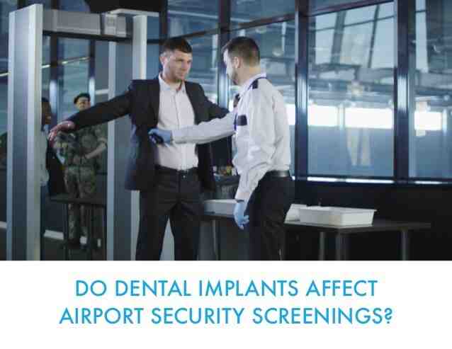 Do dental implants set off airport scanners?