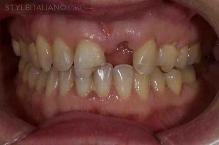 Do dentists put you to sleep for dental implants?