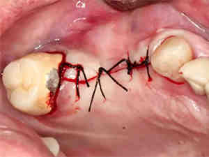 Do oral surgeons put you to sleep for implants?