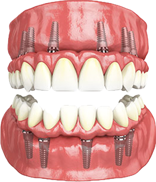 Do titanium implants set off airport metal detectors?