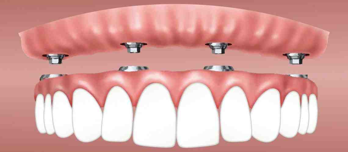 Do you get put to sleep for tooth implant?