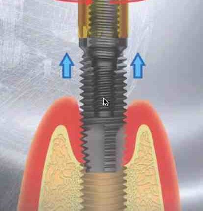 Does it hurt to have dental implant removed