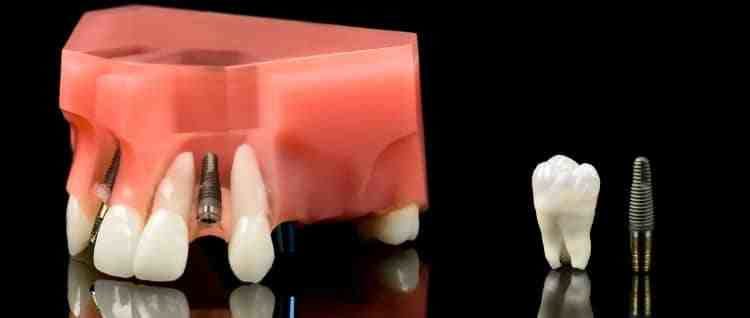 Does putting in a dental implant hurt