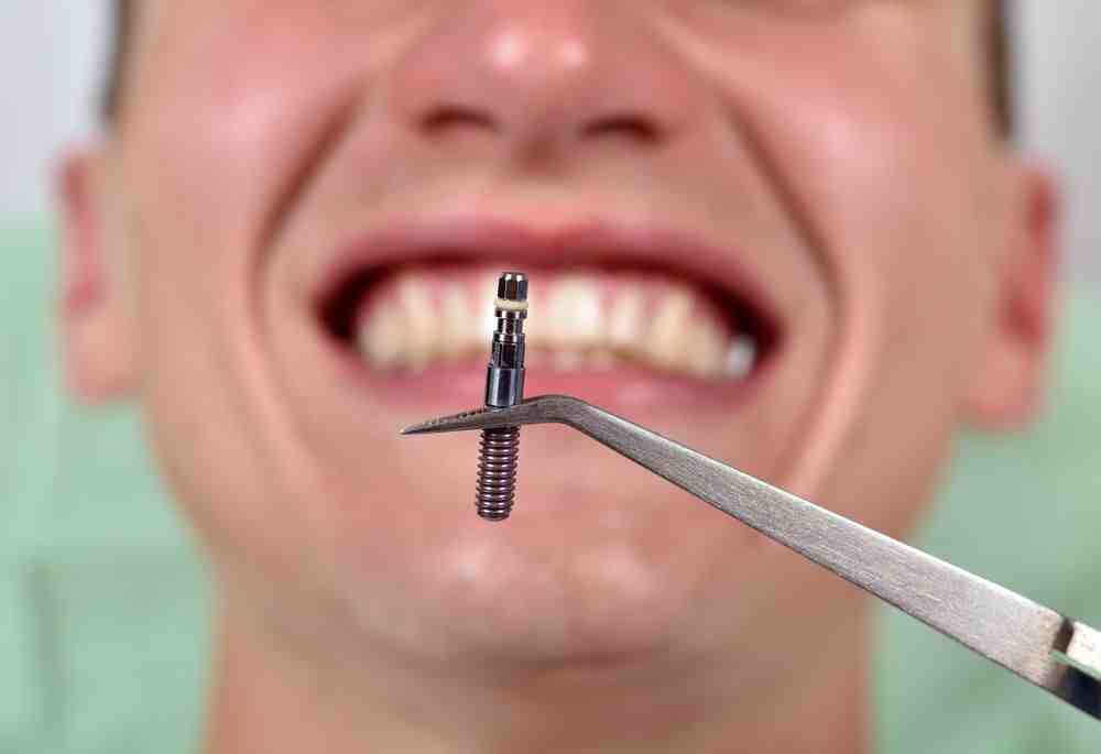 Has anyone ever died from dental implants?