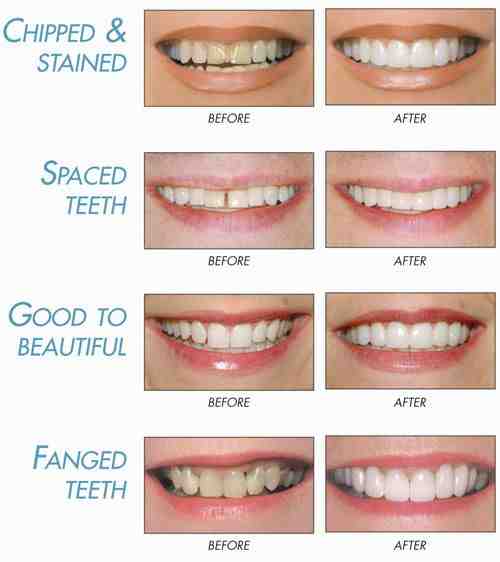 How Much Does a full dental makeover cost?