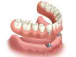 How are dental implants done step by step?