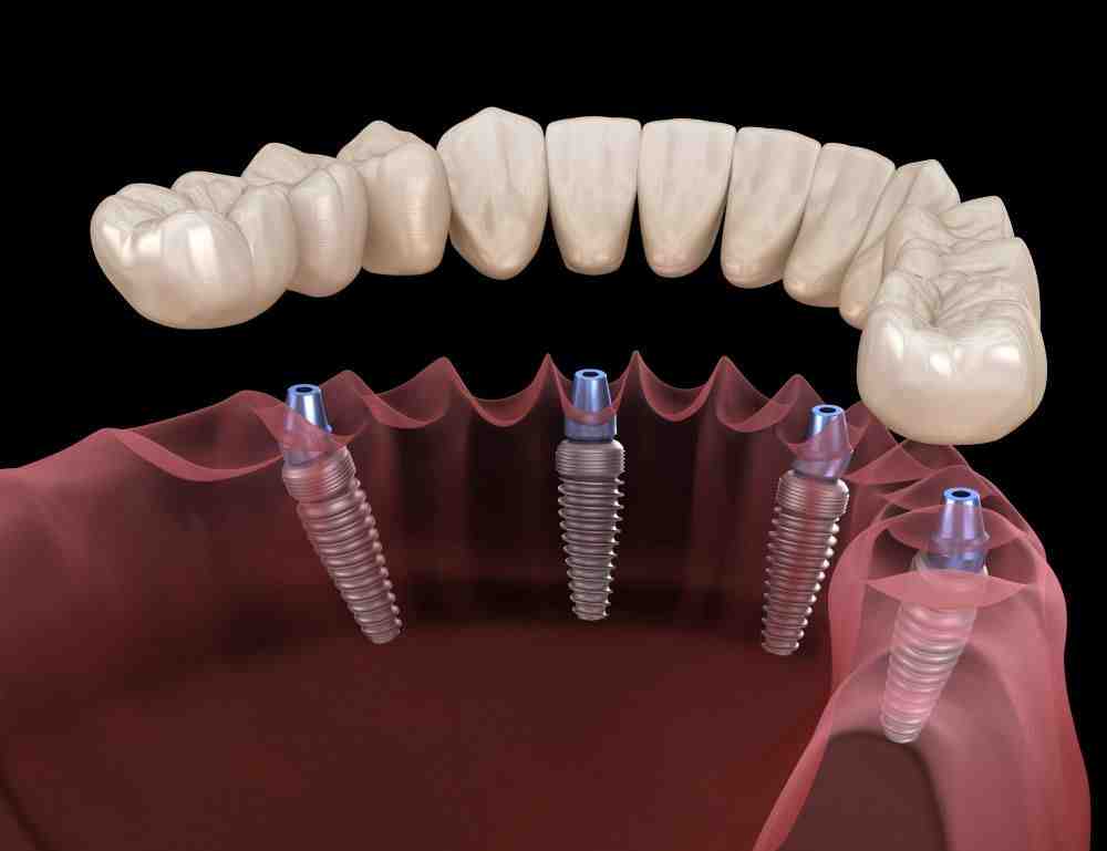 How common are dental implants?