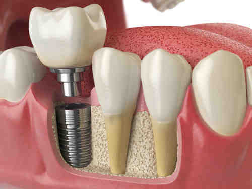 How do I choose a dental implant specialist?