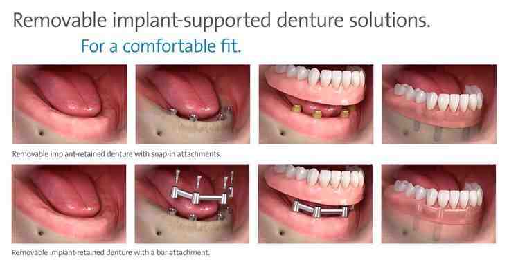 how-can-i-get-dental-implants-for-free-dental-news-network