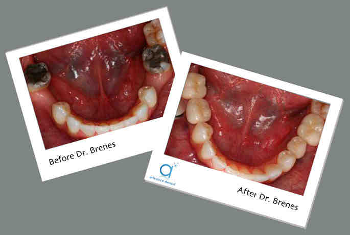 How do you know if you have enough bone for dental implants?