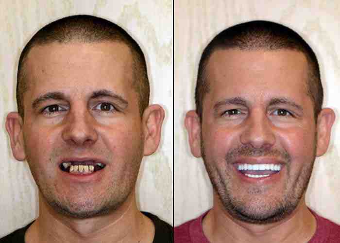 How do you pay for full dental implants?