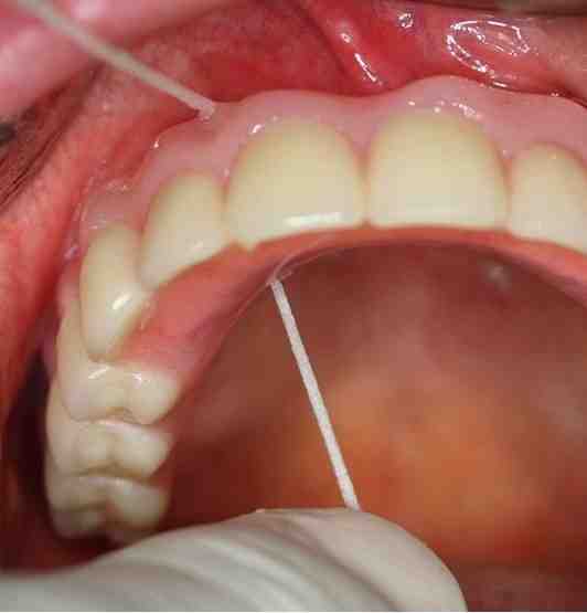 How to clean my dental implants Dental News Network