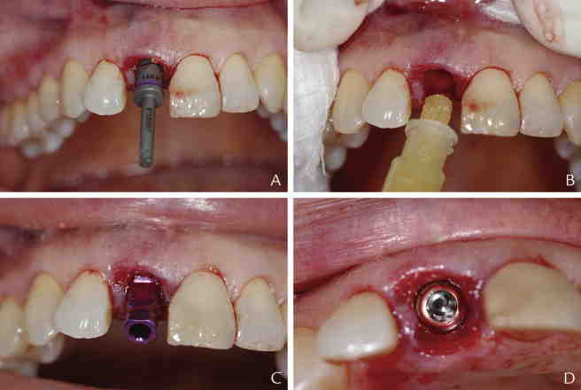 How does rheumatoid arthritis affect dental implants?