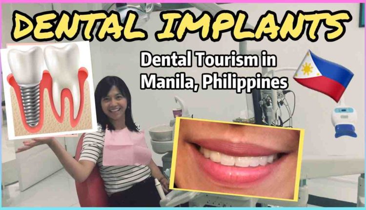 How expensive is dental implants