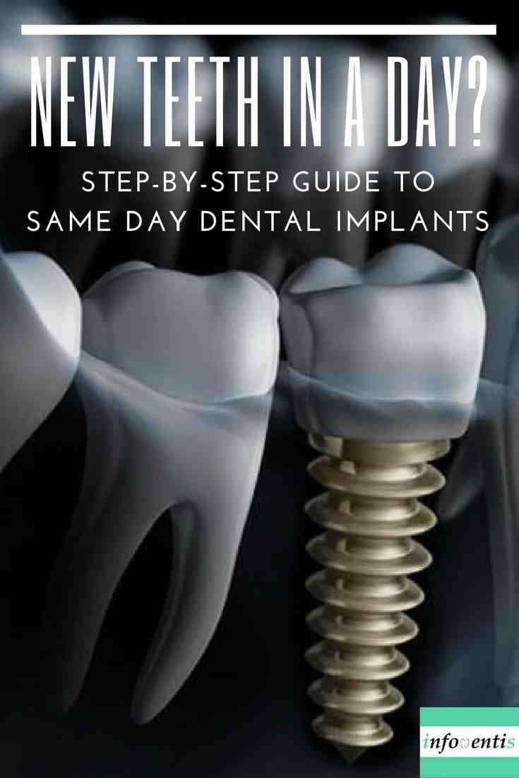How fast can dental implants be done?