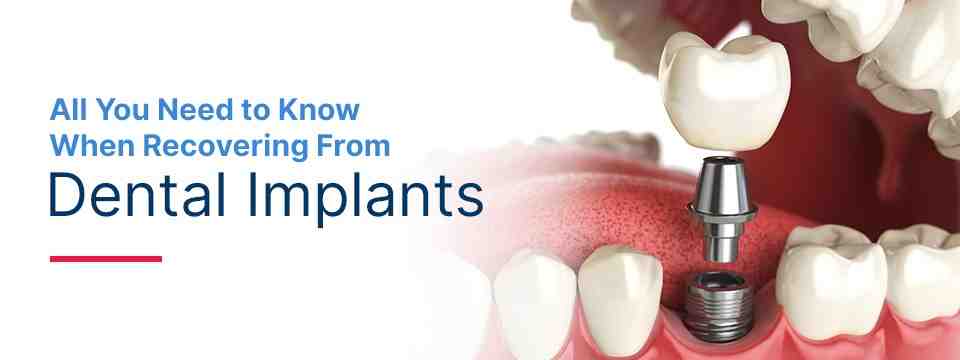 How long after getting dental implants can I eat normally?