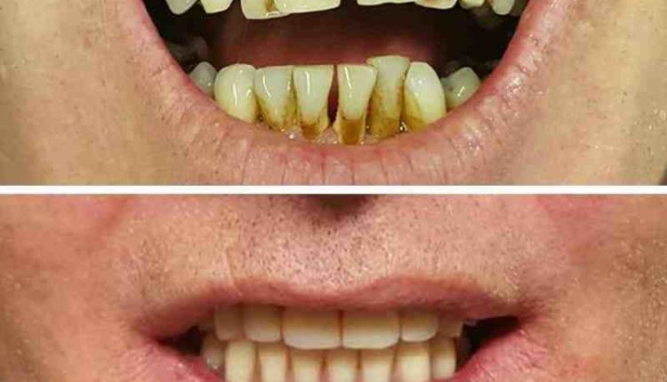 How long are dental implants guaranteed for