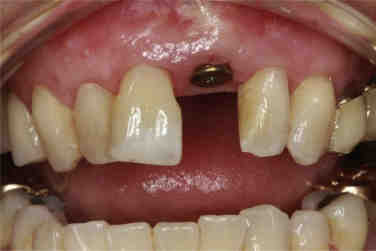 How long before dental implants settle?